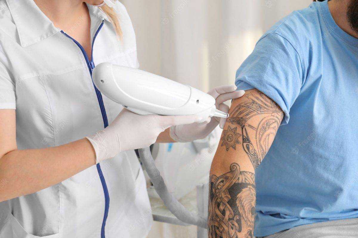 Laser Tattoo removal