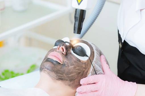 Carbon Laser treatment